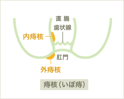 痔核（いぼ痔）