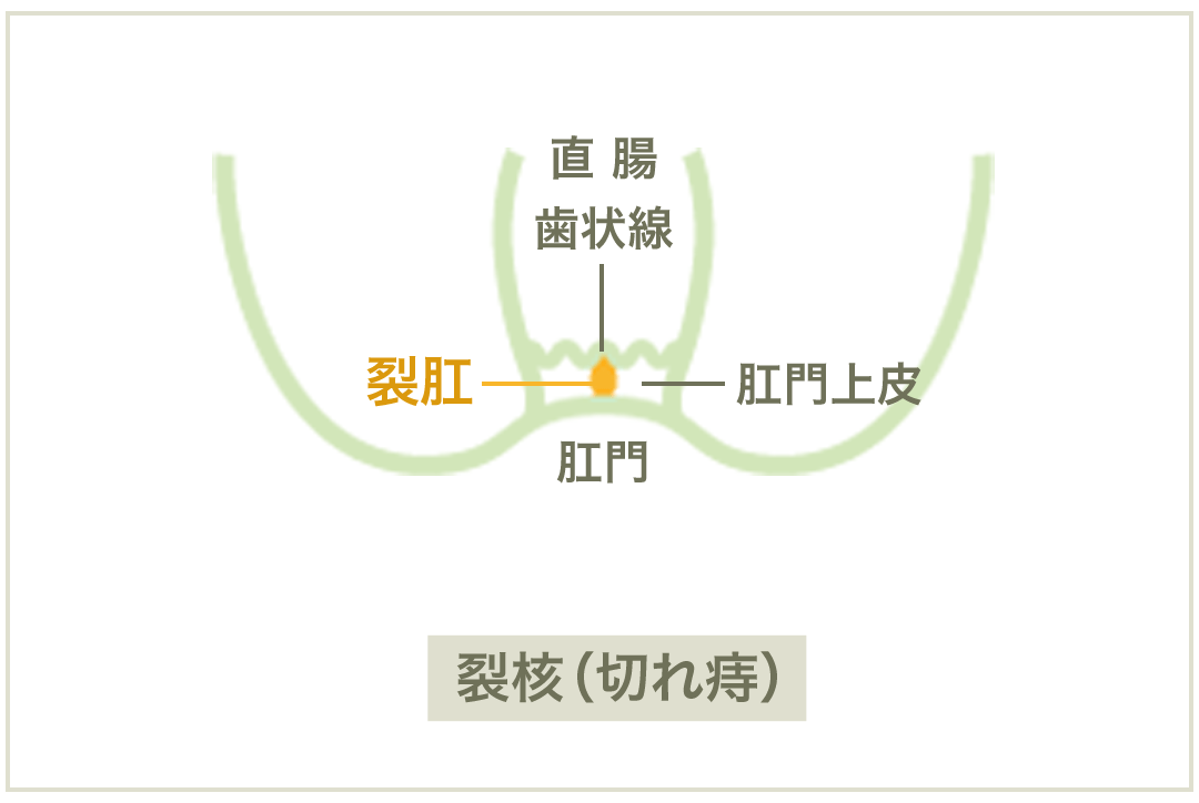 裂肛（切れ痔）